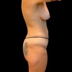 Brazilian Butt Lift Before & After Patient #10244