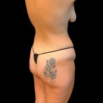 Brazilian Butt Lift Before & After Patient #10244