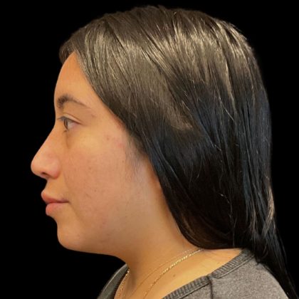 Rhinoplasty Before & After Patient #9786
