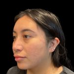 Rhinoplasty Before & After Patient #9786