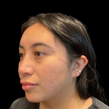 Rhinoplasty Before & After Patient #9786