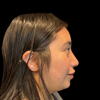 Rhinoplasty Before & After Patient #9786
