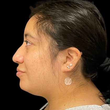 Rhinoplasty Before & After Patient #9786