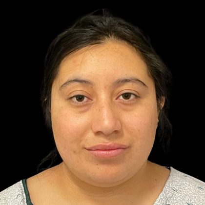 Rhinoplasty Before & After Patient #9786