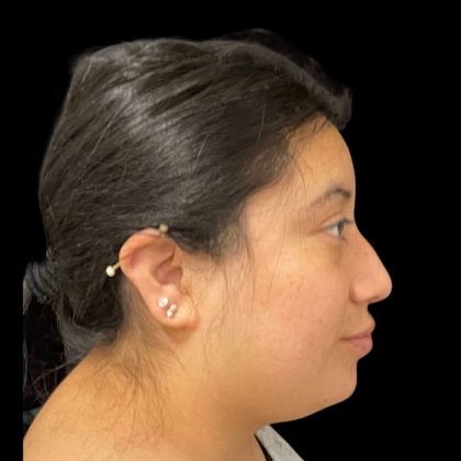 Rhinoplasty Before & After Patient #9786