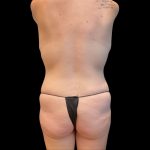 Tummy Tuck Before & After Patient #10173