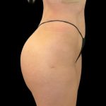 Brazilian Butt Lift Before & After Patient #10012