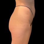 Brazilian Butt Lift Before & After Patient #10012