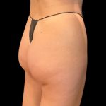 Brazilian Butt Lift Before & After Patient #10012