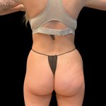Rib Repositioning Before & After Patient #10065