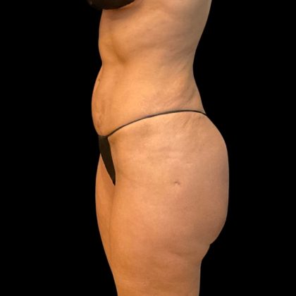 Brazilian Butt Lift Before & After Patient #10104
