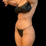 Soft Definition Liposuction Before & After Patient #10237