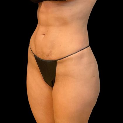 Brazilian Butt Lift Before & After Patient #10104