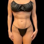 Soft Definition Liposuction Before & After Patient #10237
