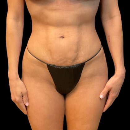 Brazilian Butt Lift Before & After Patient #10104