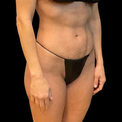 Brazilian Butt Lift Before & After Patient #10104