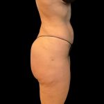 Brazilian Butt Lift Before & After Patient #10104