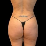 Brazilian Butt Lift Before & After Patient #10104
