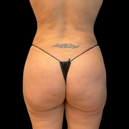 Brazilian Butt Lift Before & After Patient #10104