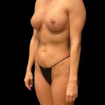 Soft Definition Liposuction Before & After Patient #10237