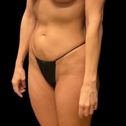 Brazilian Butt Lift Before & After Patient #10104