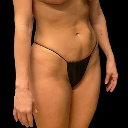 Brazilian Butt Lift Before & After Patient #10104