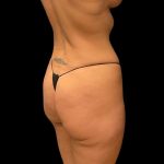 Brazilian Butt Lift Before & After Patient #10104