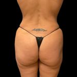 Brazilian Butt Lift Before & After Patient #10104