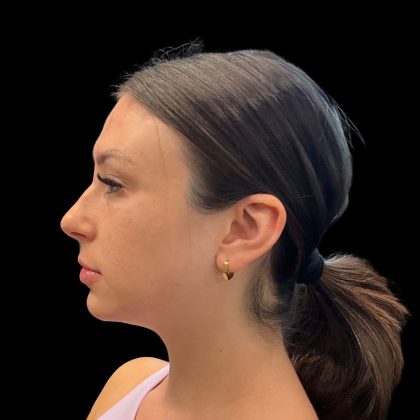 Lumecca Before & After Patient #10181