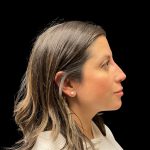 Liquid Rhinoplasty Before & After Patient #10182