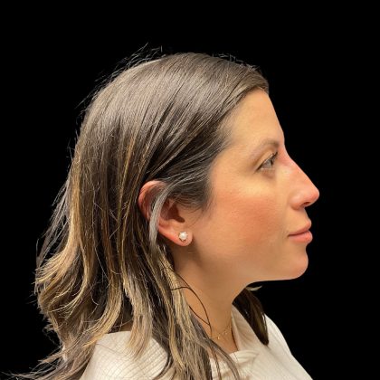 Liquid Rhinoplasty Before & After Patient #10182
