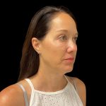 Sculptra Before & After Patient #10184