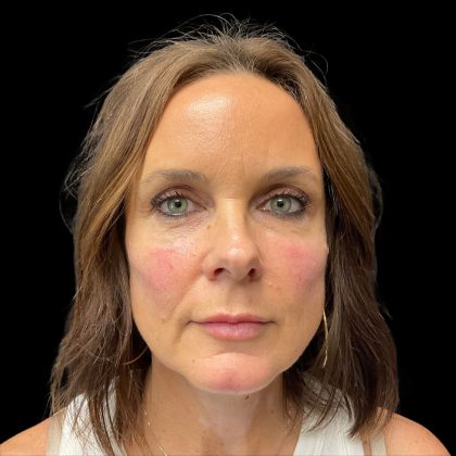 Cheek Filler Before & After Patient #10230