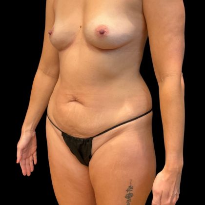 Mommy Makeover Before & After Patient #10145