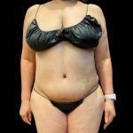 Tummy Tuck Before & After Patient #10052