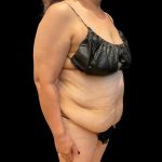 Tummy Tuck Before & After Patient #10052