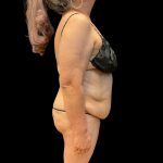 Tummy Tuck Before & After Patient #10052