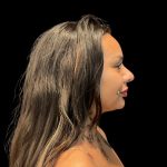 Liquid Rhinoplasty Before & After Patient #10093