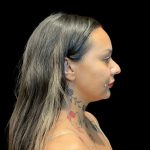 Liquid Rhinoplasty Before & After Patient #10093