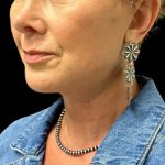 Facelift Before & After Patient #10082