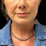 Facelift Before & After Patient #10082