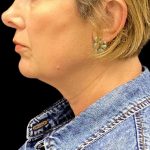 Facelift Before & After Patient #10082