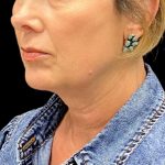 Facelift Before & After Patient #10082