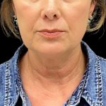 Facelift Before & After Patient #10082