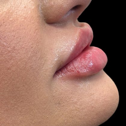 Lip Filler Before & After Patient #9839