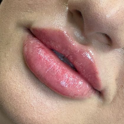 Lip Filler Before & After Patient #9839