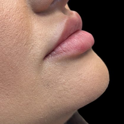 Lip Filler Before & After Patient #9839
