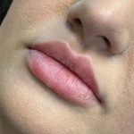 Lip Filler Before & After Patient #9839