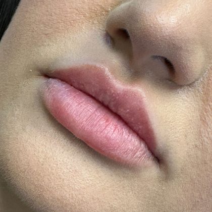 Lip Filler Before & After Patient #9839
