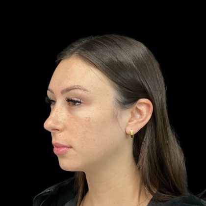 Lumecca Before & After Patient #10181
